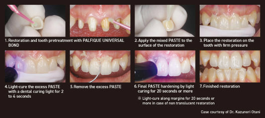 Estecem Plus ( bond + resin cement ) Tokuyama