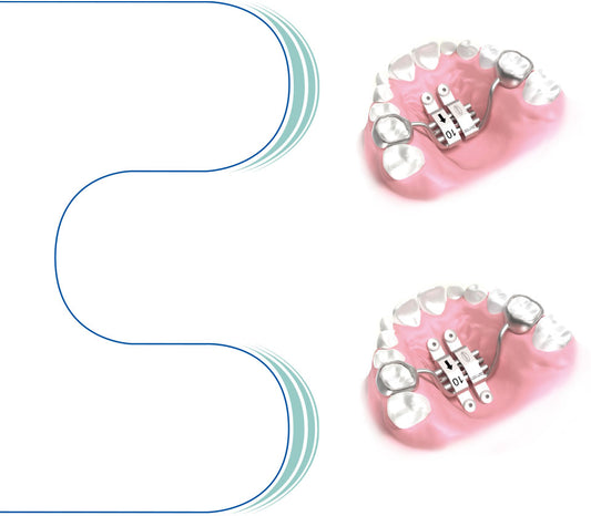 Palatal Expander for TADs leone