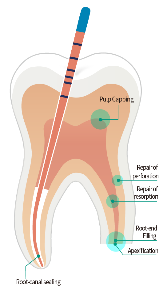 Bioceramic sealer Sure-endo