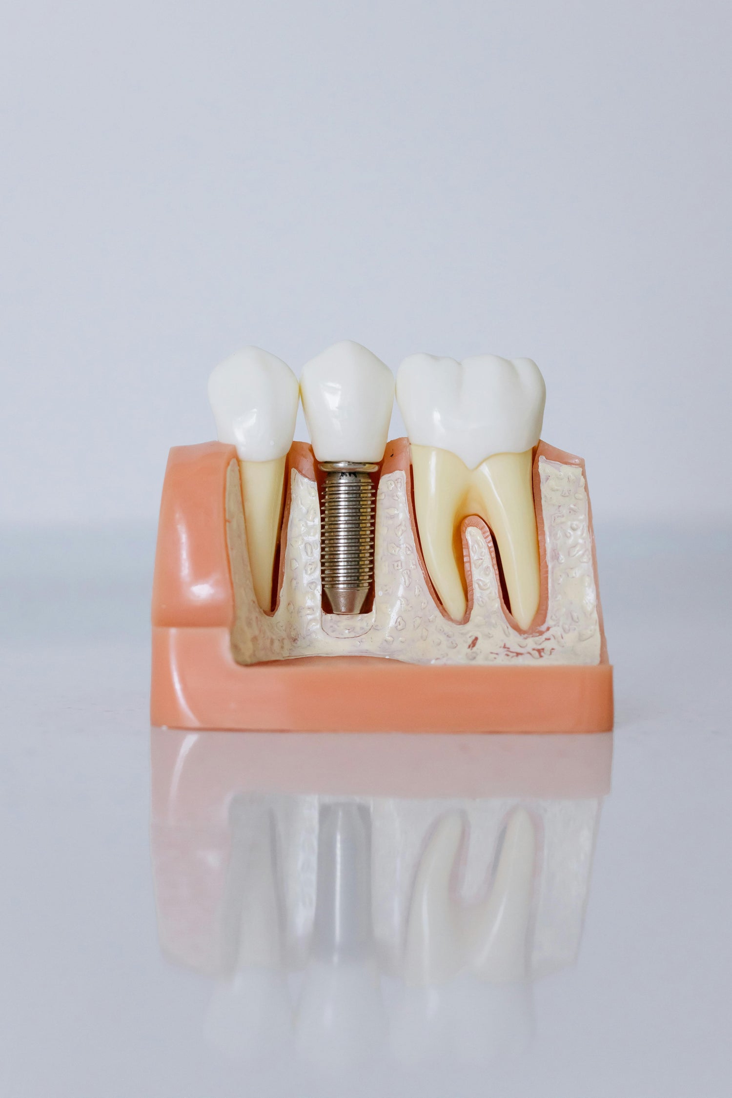Implant